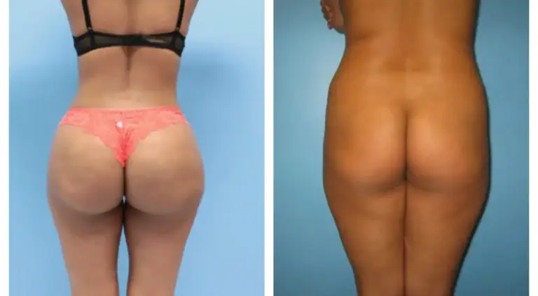 bbl-brazylijski-lifting-pośladków-12-wrocław