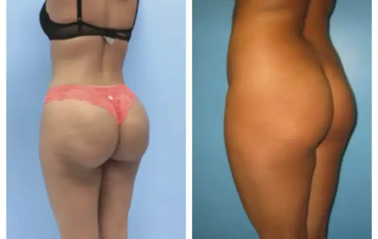 bbl-brazylijski-lifting-pośladków-13-wrocław