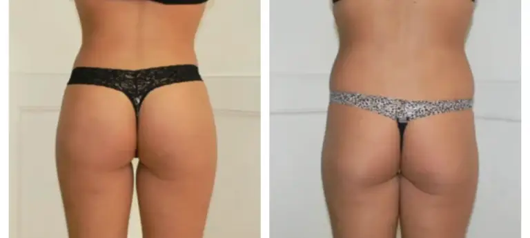 bbl-brazylijski-lifting-pośladków-2