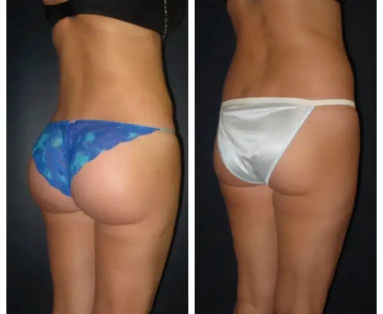 bbl-brazylijski-lifting-pośladków-3