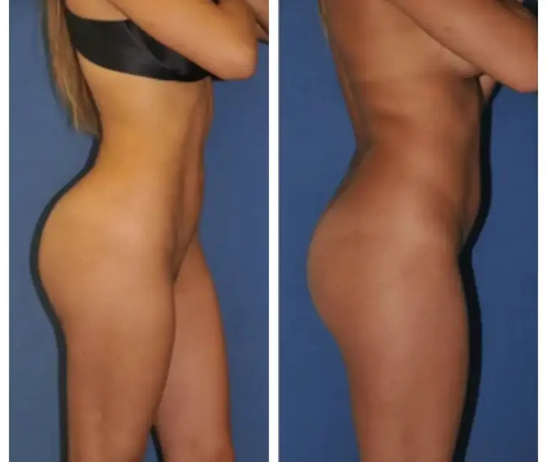 bbl-brazylijski-lifting-pośladków-4