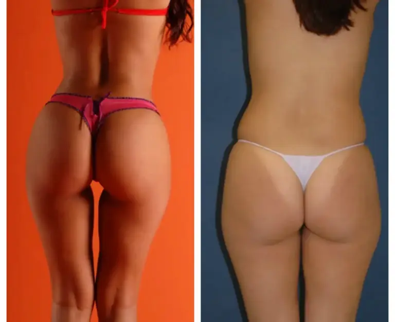 bbl-brazylijski-lifting-pośladków-5