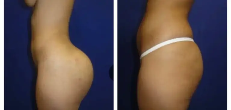 bbl-brazylijski-lifting-pośladków-6