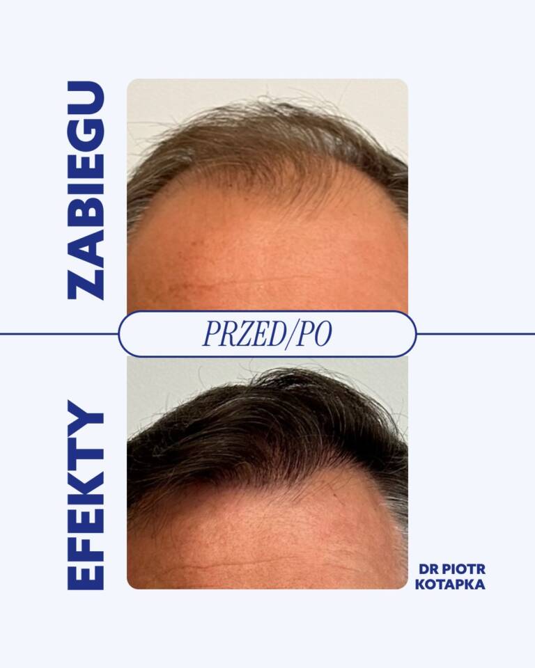 opinie-piotr-kotapka-przeszczep-włosów-wrocław