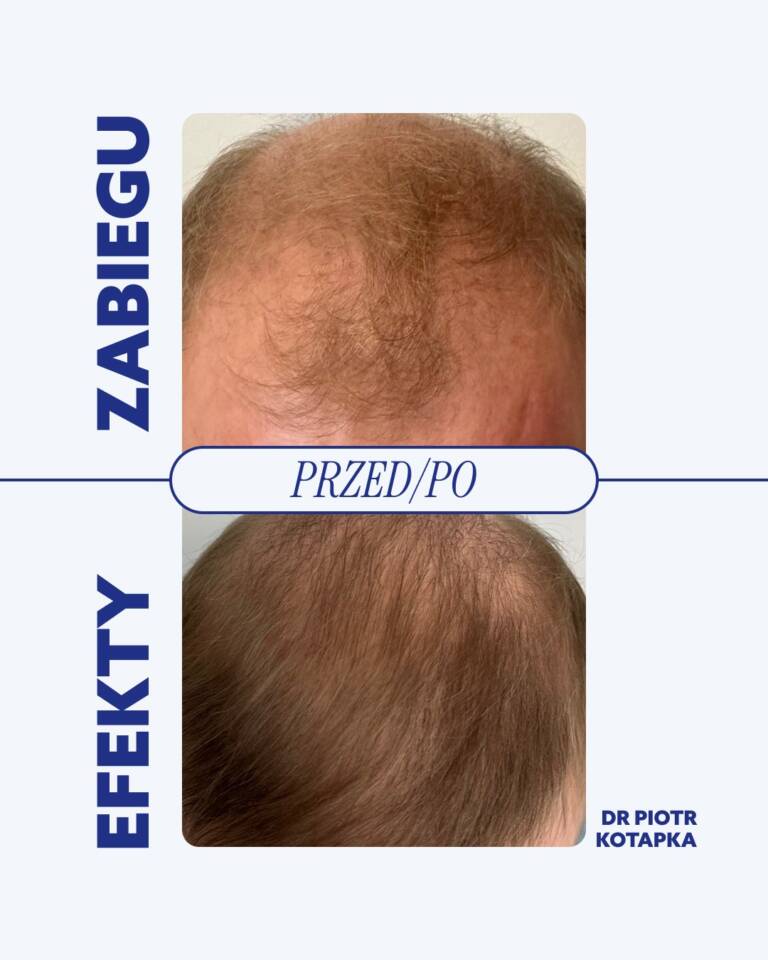 piotr-kotapka-przeszczep-wrocław