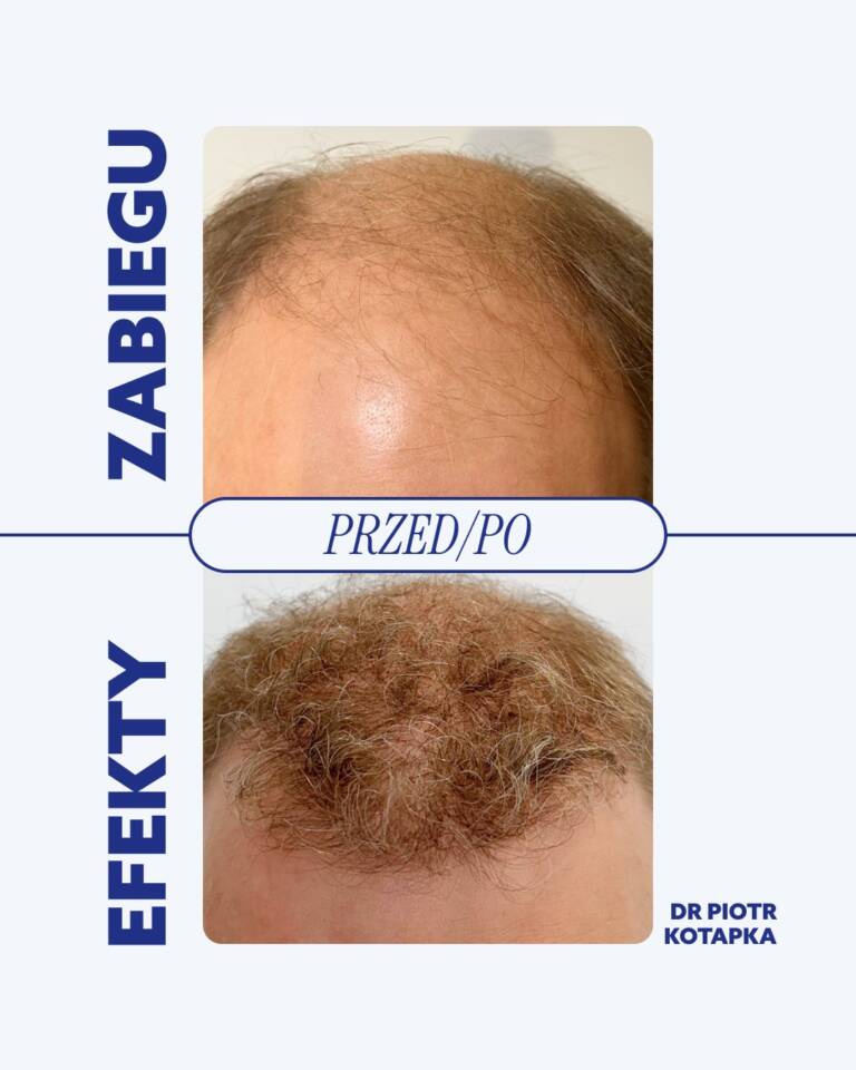 przeszczep-włosów-fue-wrocław