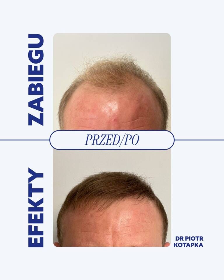 przeszczep-włosów-wrocław