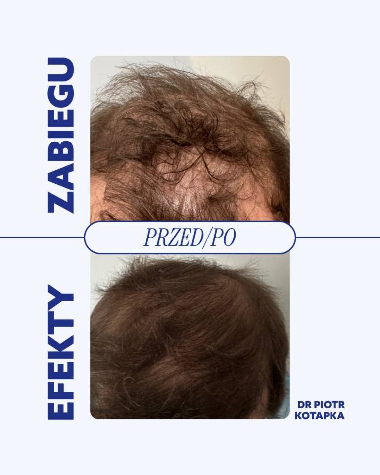 przeszczep-wrocław-fue-efekty