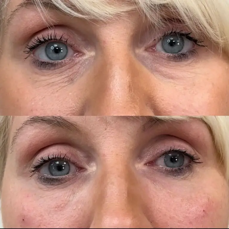 wypełnianie-doliny-łez-wrocław-tesoro-clinic