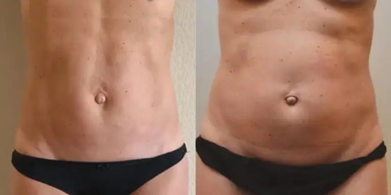 liposukcja-brzucha-tesoro-wrocław-3