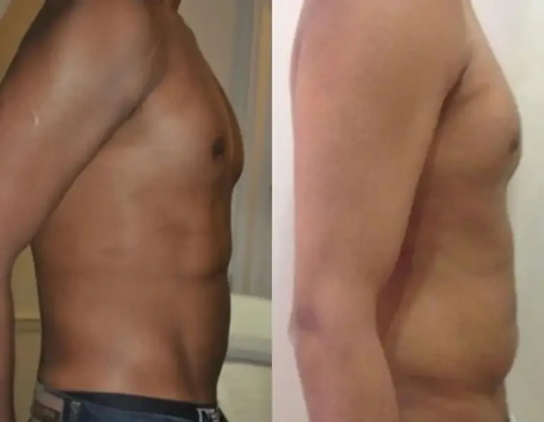 liposukcja-brzucha-tesoro-wrocław