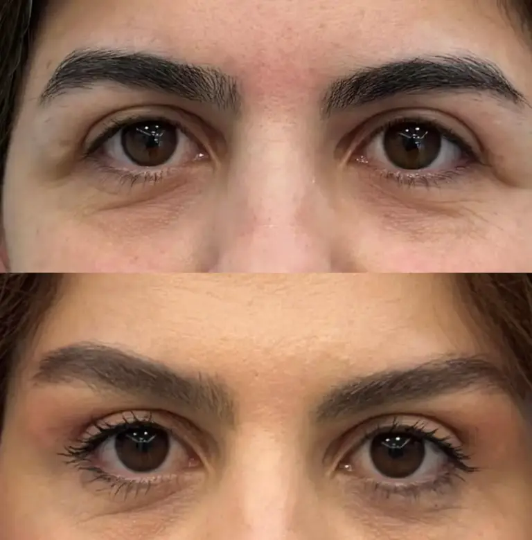 lifting brwi naciecie wzdluz naturalnej linii wroclaw tesoro clinic