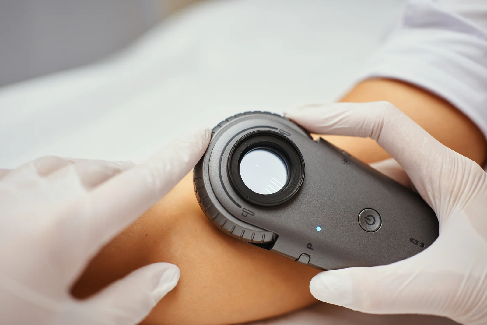 Badanie skóry ramienia dermatoskopem trzymanym w dłoniach w rękawiczkach